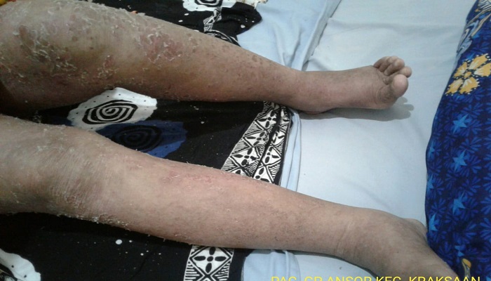 Kondisi Robiah (foto: pilihanrakyat.id)